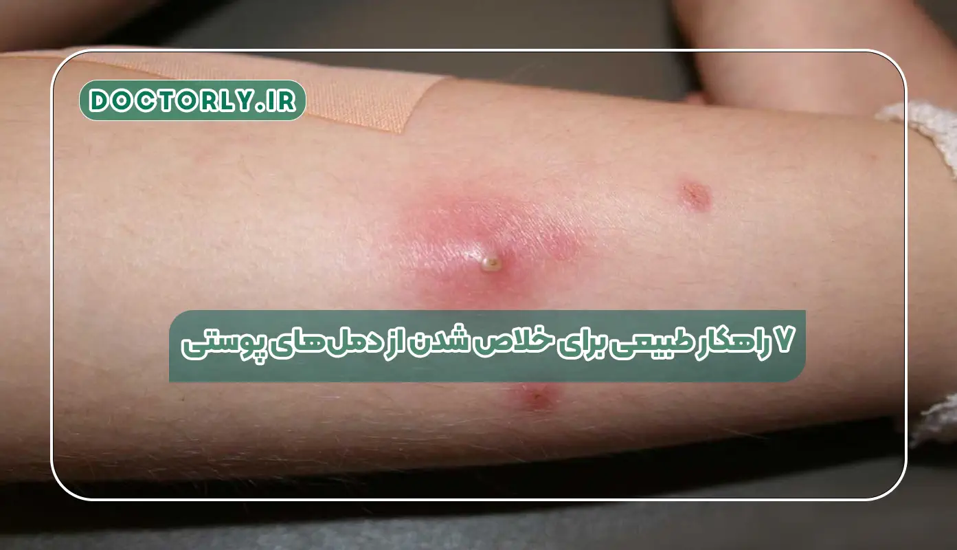 ۷ راهکار طبیعی برای خلاص شدن از دملهای پوستی